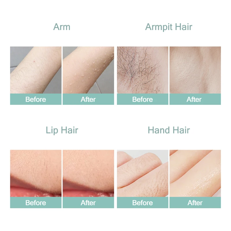 laser painless portable depilation hair removal 808nm diode laser machine 808 755 1064 diode laser for sale