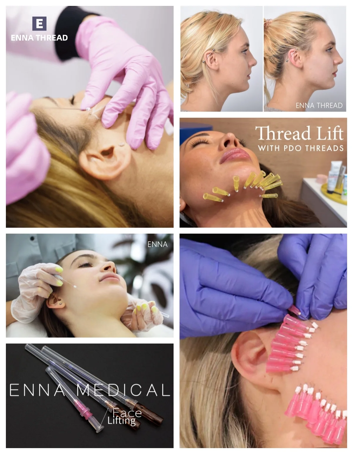 Vigor wholesale pdo thread lift nasal tip treatment gold thread face lift pdo cog 6d thread 19g 18g 100mm 120mm