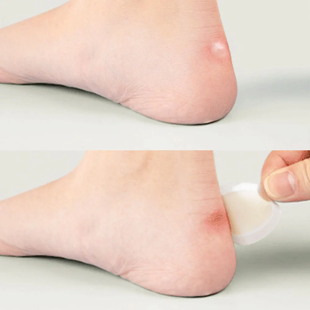 Advanced Medical Hydrocolloid Foot Care Plaster Acne Wound Dressing Blister Plaster