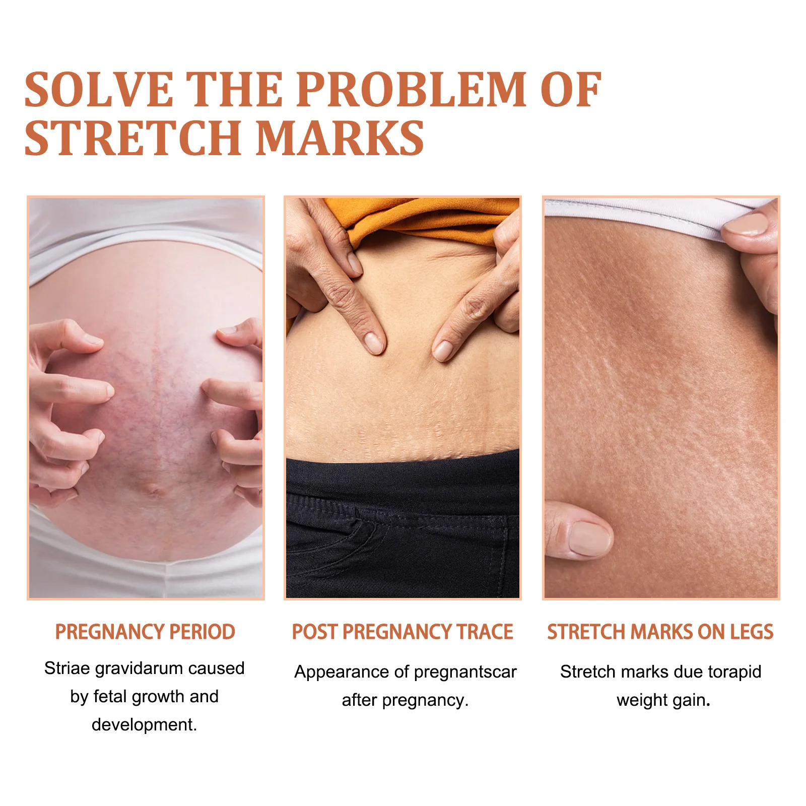 wholesale postpartum stretch mark cream abdomen thighs leg buttocks chest pregnancy stretch mark removal cream for female