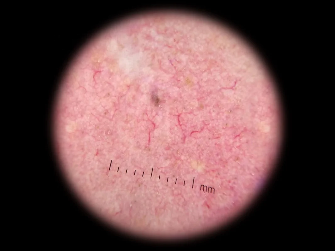 IBOOLO DE-300 Polarized Skin Analyzer Scope Machine, Mobile Phone Dermatoscope