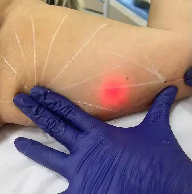 Endolaser diode 980 nm 1470 vaser liposucion 1470nm diode laser single wavelength face lifting endoskin laser devise