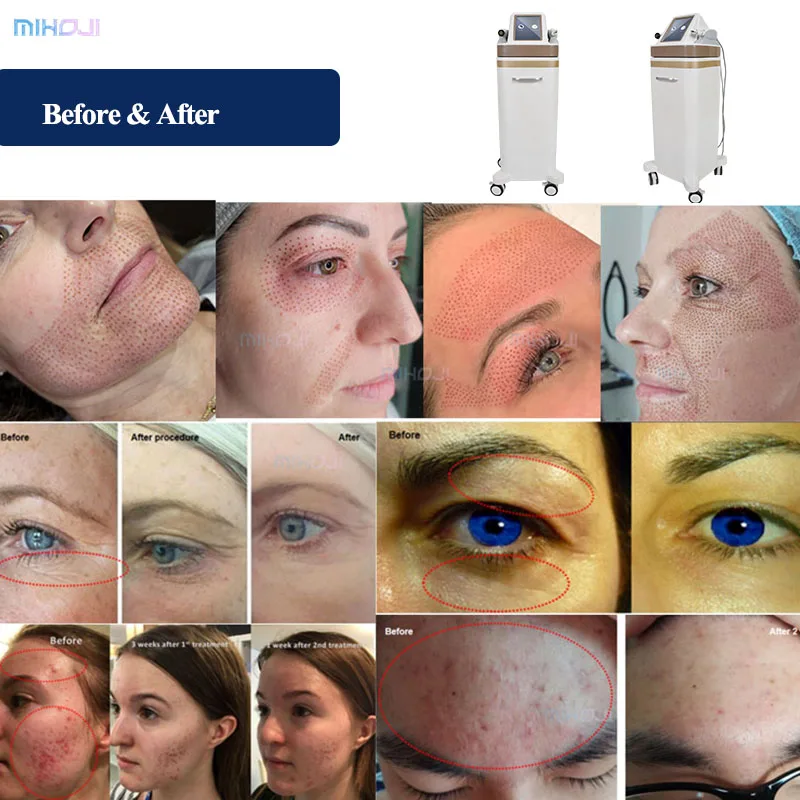 Plasma pen fractional needles skin tightening cold ozone professional jet plasma pen