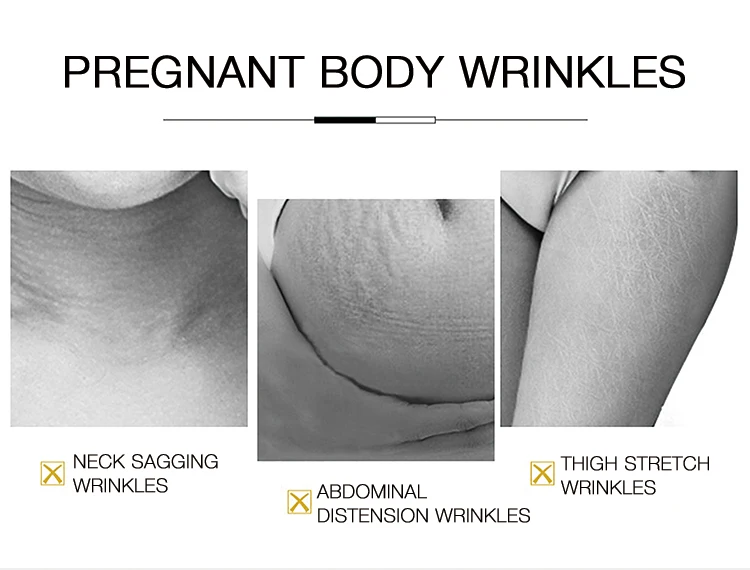 Essing Newest Innovation No-surgical For Beauty Center Stretch Mark Removal Machine