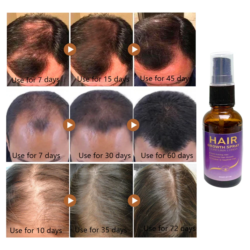 New Ginger Hair Care Growth Serum Hair Loss Treatment Spray 7 Days Effective Germinal Hair Growth Essential Oil