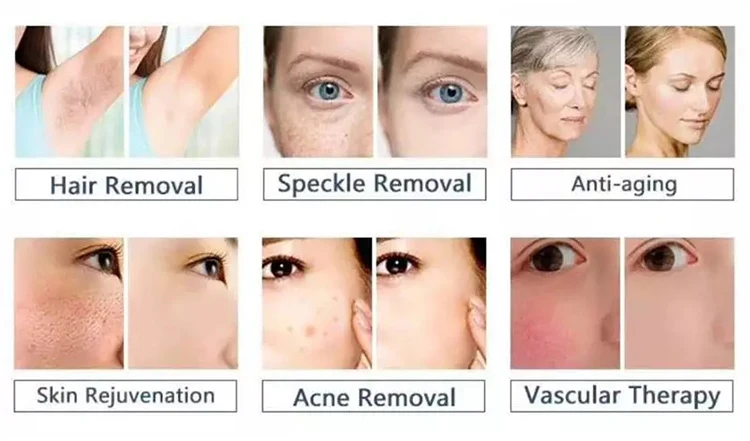 Photofacial ipl rf elight machine/big shot opt shr hair removal /ipl machine