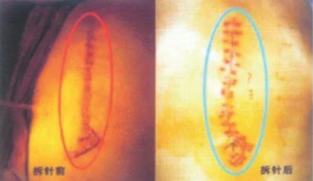 OEM/ODM service medical Skin Wound Stapler 35w Stapler Skin