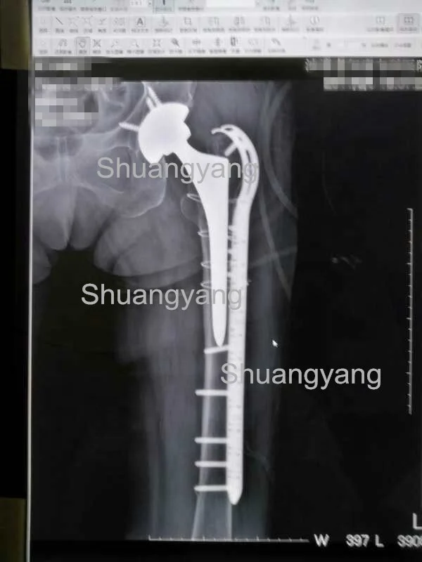 Titanium cable and locking plate Implant for Orthopedic femur fractures (Cerclage Wire)
