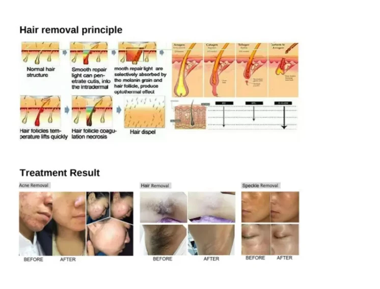 Hot Sale Dpl Laser Machine Skin Rejuvenation Acne Pigmentation Treatment Machine Dpl elight ipl