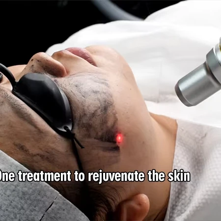 2025 Professional Wholesale Price Q-switch Nd Yag Portable Laser Tattoo Removal Machine nd yag laser for sale