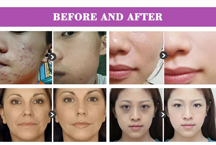 X5 Hot Dr.Pen X5 Professional Electric Painless Wireless Ultima X5 Microneedle MTS Needles Cartridges Dermapen