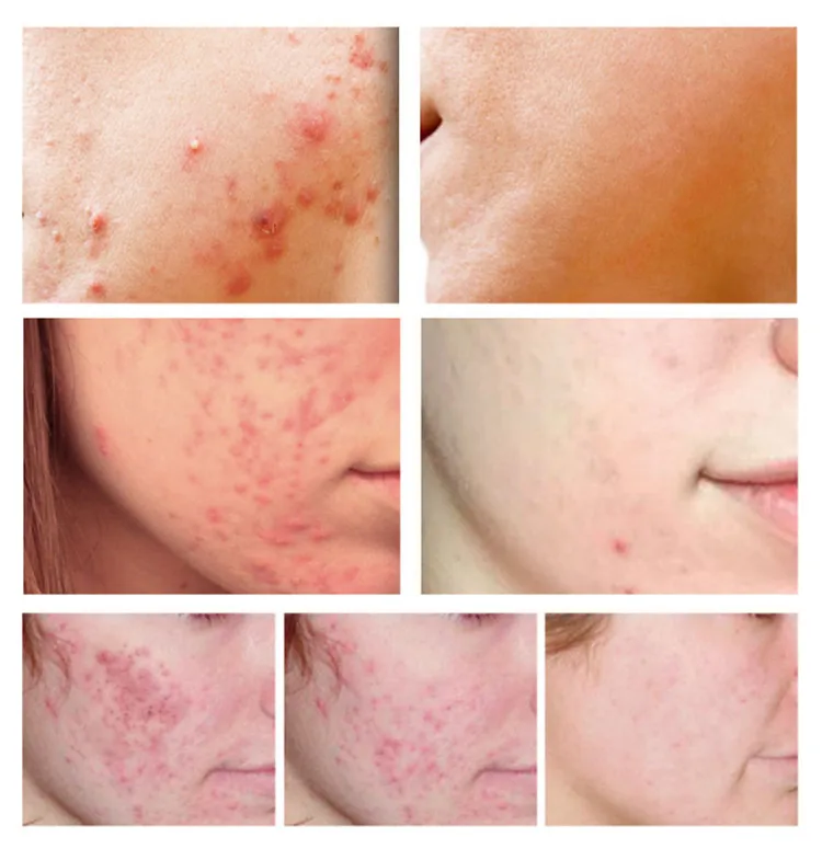 Yeast Repair Essence Acne Treatment Serum Facial Anti Acne Scar Removal Skin Care Whitening Pimple Remover Liquid Repair Serum