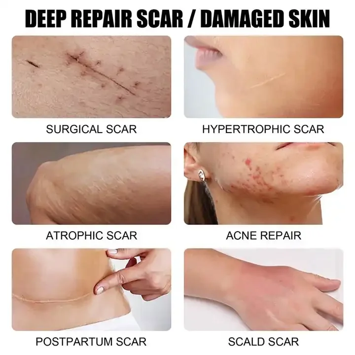 Fastest Acne Scar Removal Cream Face Care Scar Gel Bruise Repair Cream Tummy Tuck Tightening 30g Stretch Mark Scar Removal Cream