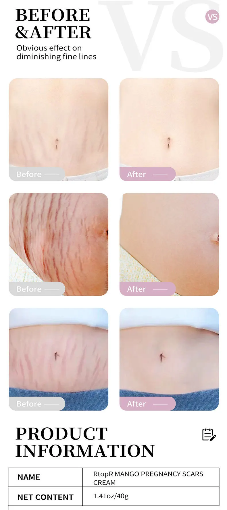 OEM ODM Natural Organic Mango Stretch Mark Repair Cream Maternity Fades Postpartum Fat Growth Orange Peel Scar Remover Skin Care