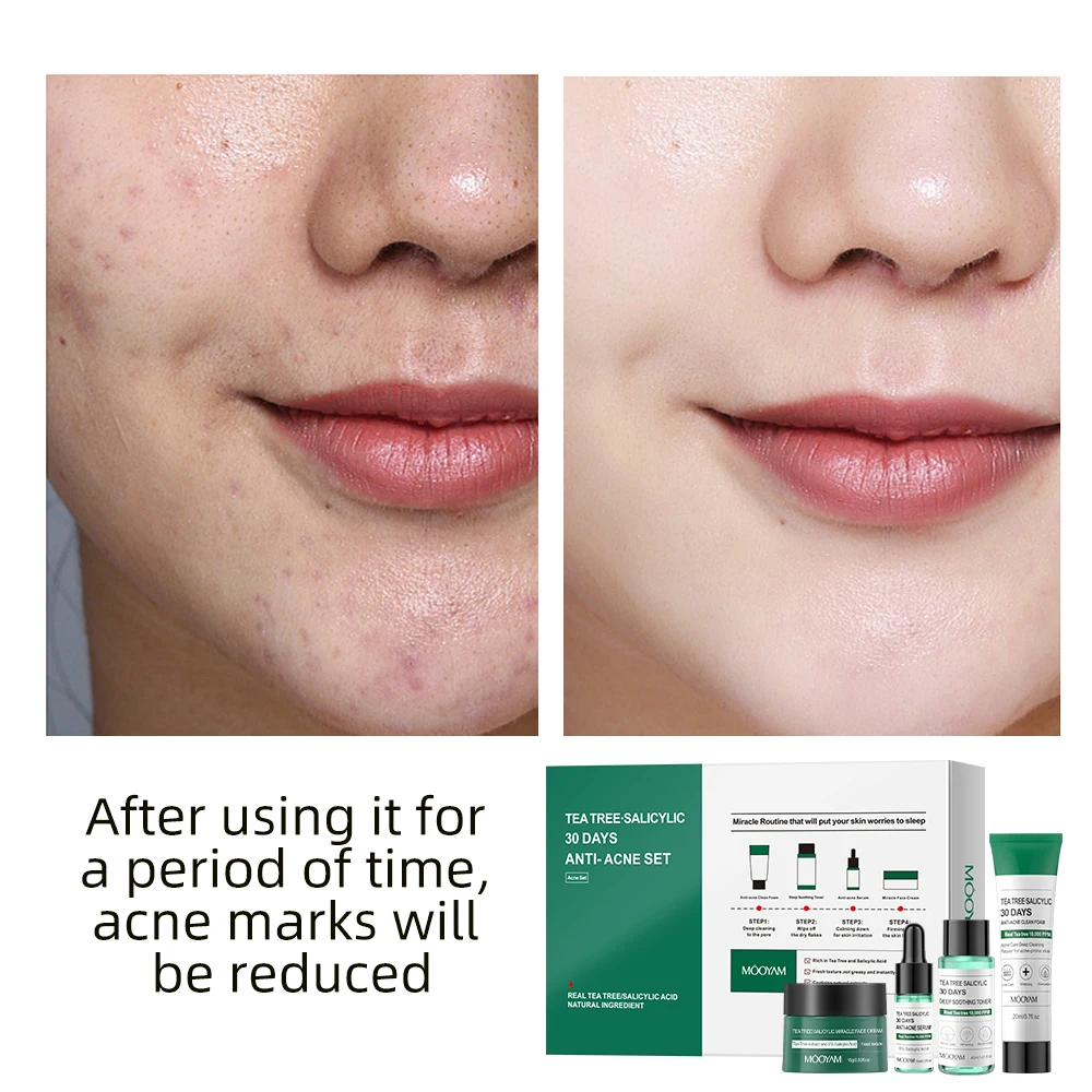 Private label Tea Tree Salicylic Acid Skin Care Set 30 Days Anti-Acne Including Cleanser Toner Serum Cream Skin Care Set