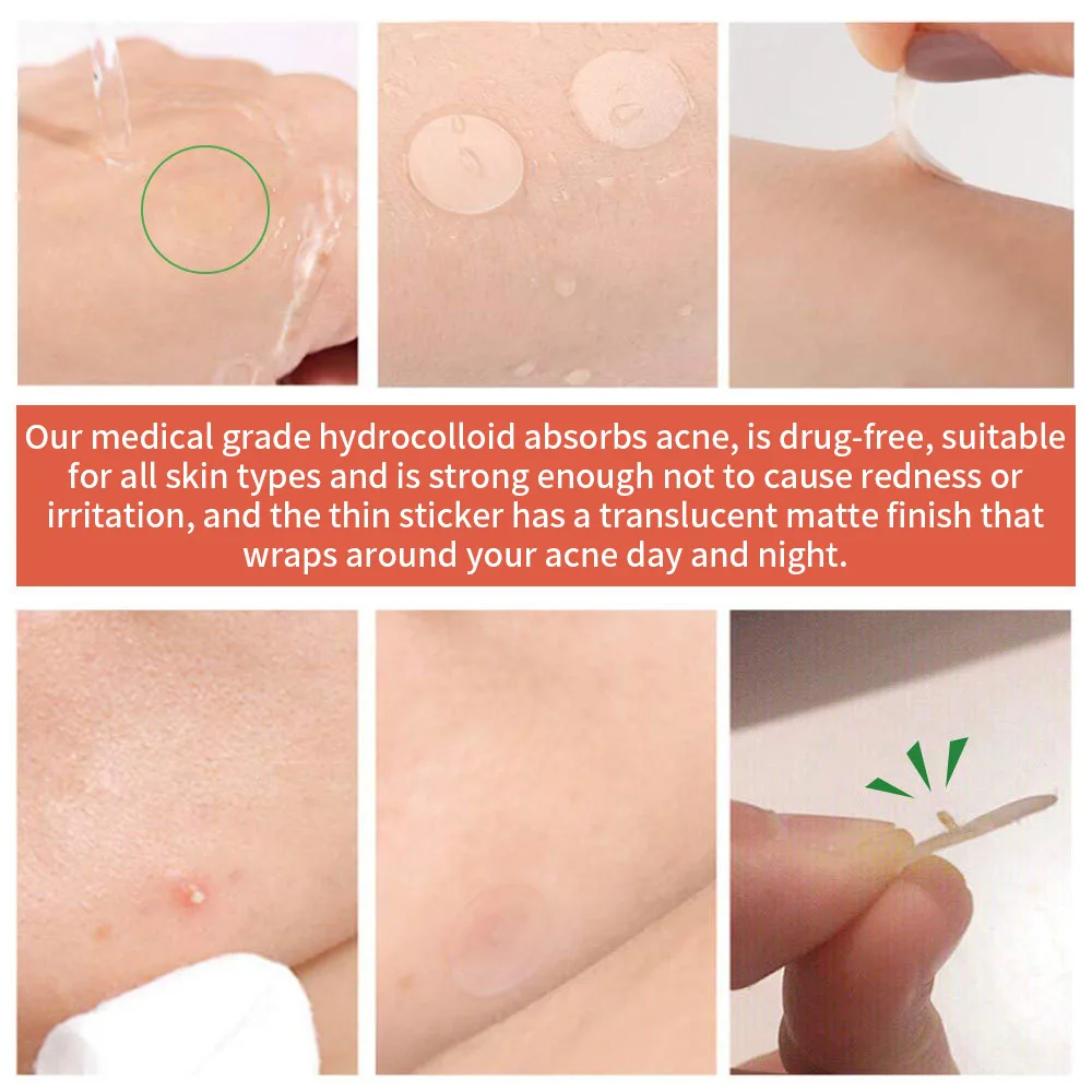 OEM Customized 72 Acne Patch Supplier Spot Repairing Treatment Original Pimple Patches Hydrocolloid blemish patch Clear Healing