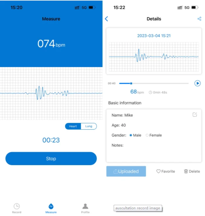Andriod/ios/windows Wireless Remote Patient Monitoring Digital Estetoscopio Stethoscope Electric CE 3.7V Lithium Battery 1years