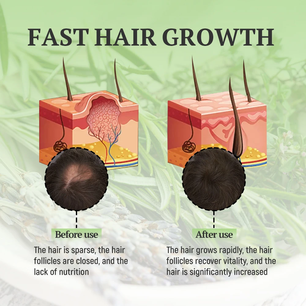 New Factory Fast Speed Organic Miele Rosemary Oil Hair Growth For Baby Natural Hair Growth Essential Oil Hair Growth Products