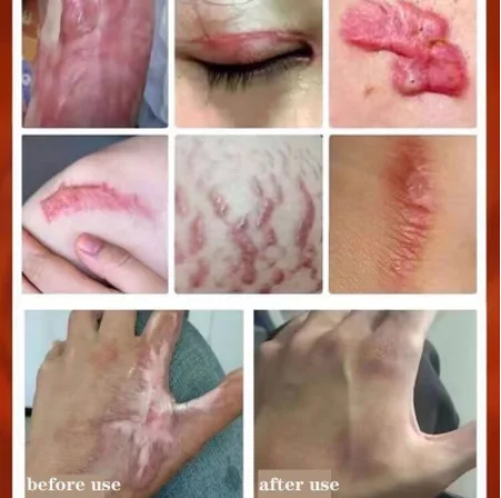 Scar repair cream desalt hyperplasia pregnancy cream operation burn skin repair