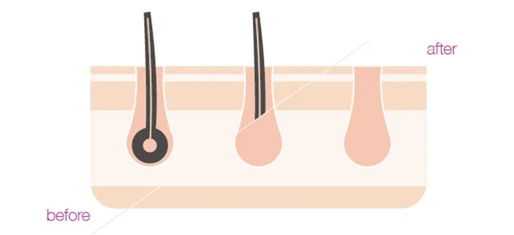 Mlay Quartz lamp For T14 IPL laser Epilator Hair Removal Skin Rejuvenation Acne clearance Heads With 500000 Shots for Mlay T14