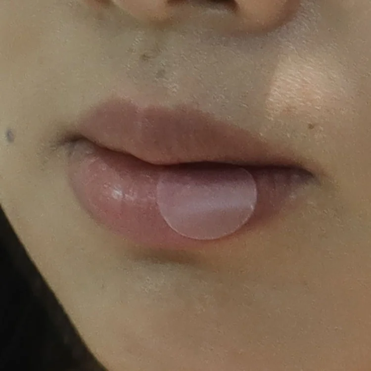 Trummed Cold Sore Patch Hydrocolloid Herpes Patch for Soothing & Hiding Cold Sores