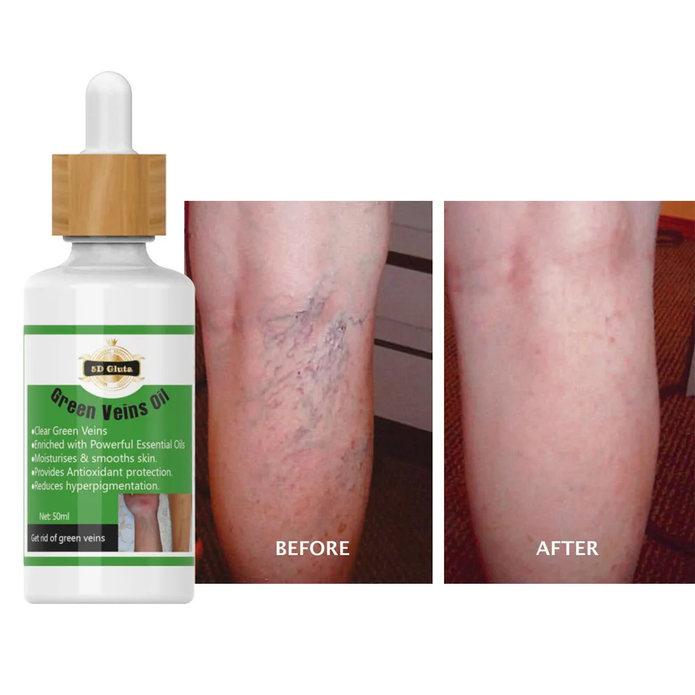 OEM Private Label Logo 5D Gluta Green Veins Oil Removing Spider Veins Mixed with Body Milk Lotion