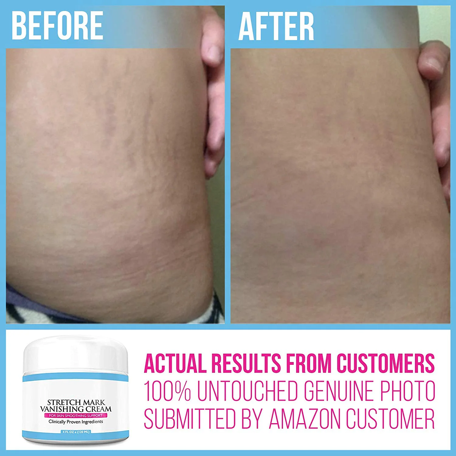 Увлажняющий Крем Для Удаления растяжек и шрамов от частной марки для ухода за телом