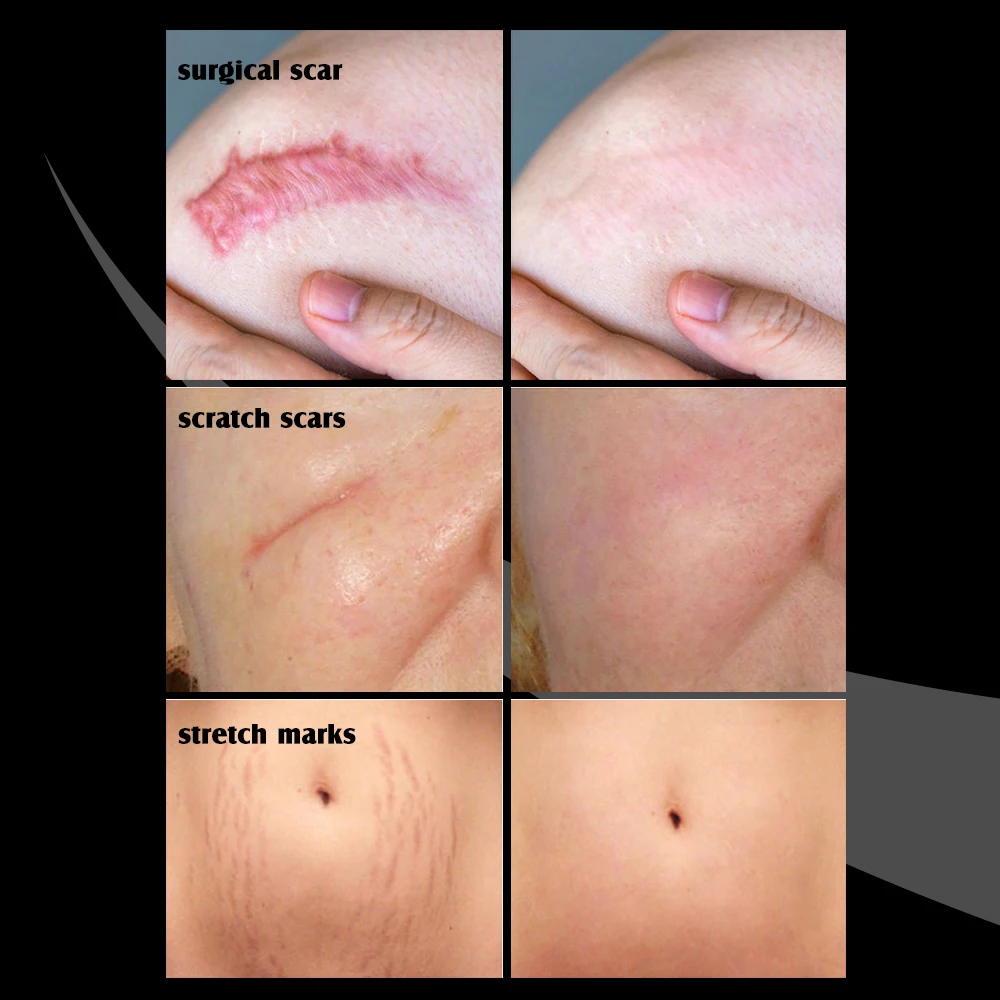 Strong Effective Acne Scar Removal Cream Smoothing Firming New Scars Stretch Marks Pimples Treatment Cream