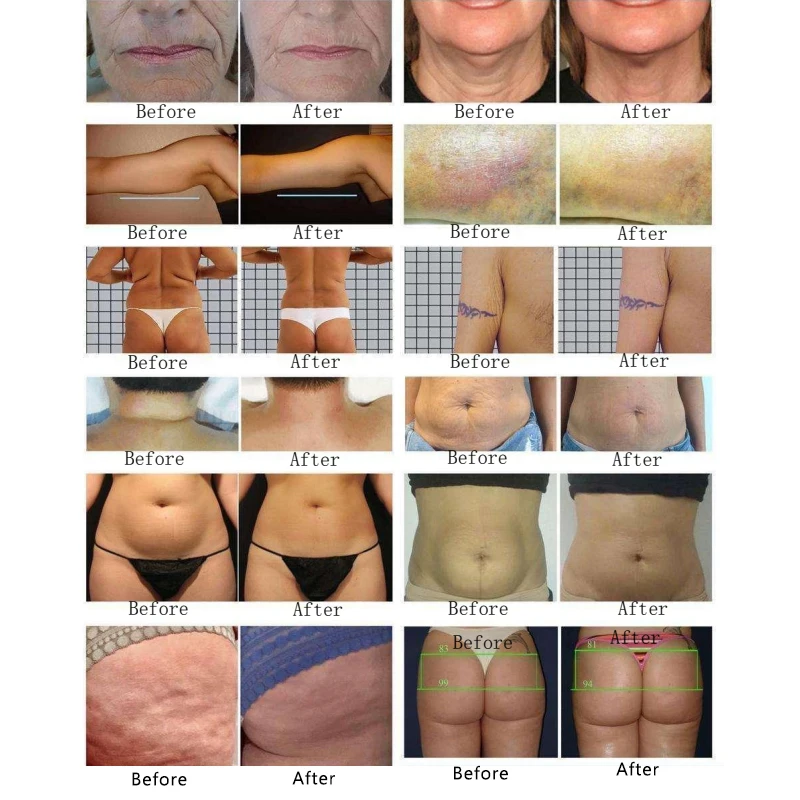 Vertical Vera slim Vacuum Rotating Roller RF Anti Cellulite Rotary Negative Pressure RF Wrinkle Remover Vera Facial Lift Machine