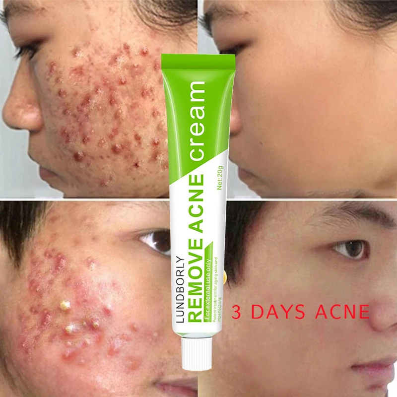 Herbal Essence Acne Scar Removal Cream vegan herbal  Extract acne-aid 3 days  Salicylic acid anti acne cream