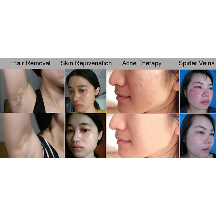 Care Hair Removal Laser Machine Ipl Laser Rf Hair Removal Skin Care Device To Remove Hair Brown