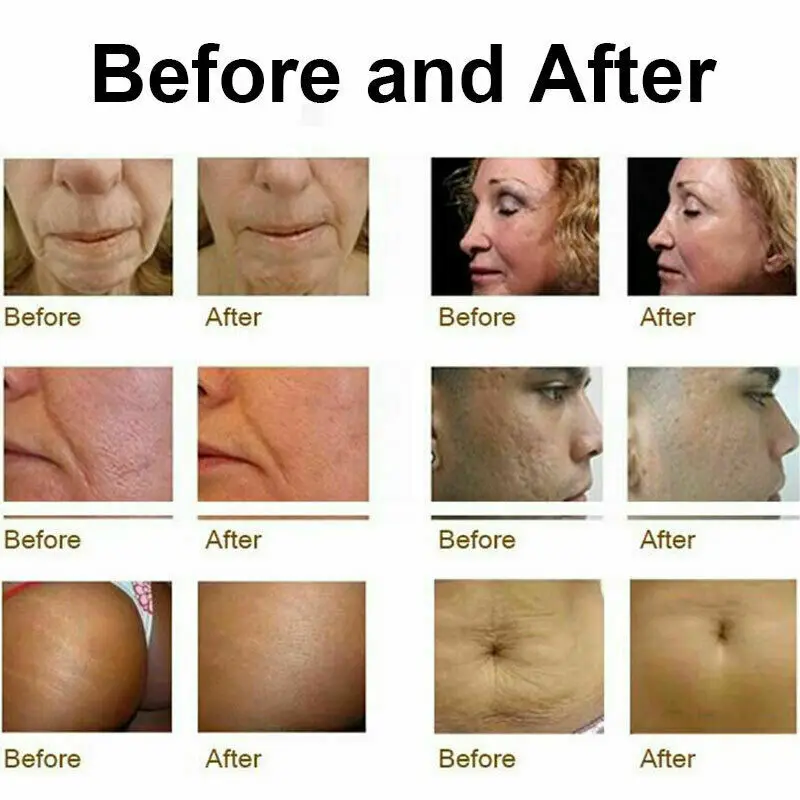 Professional Fractional Radio Frequency Skin Tightening RF Frecuencia RF Facial Machine