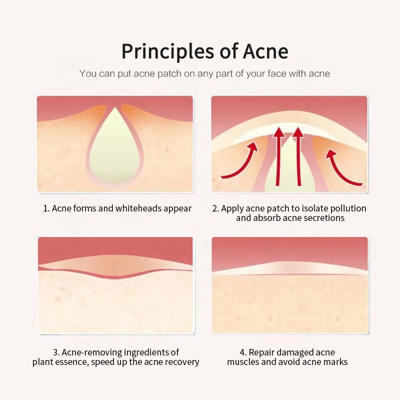 Hot Sale Cosmetics Acne Concealer Salicylic VC Healing Anti-Acne Pimple Patches Treatment Mask Wholesale