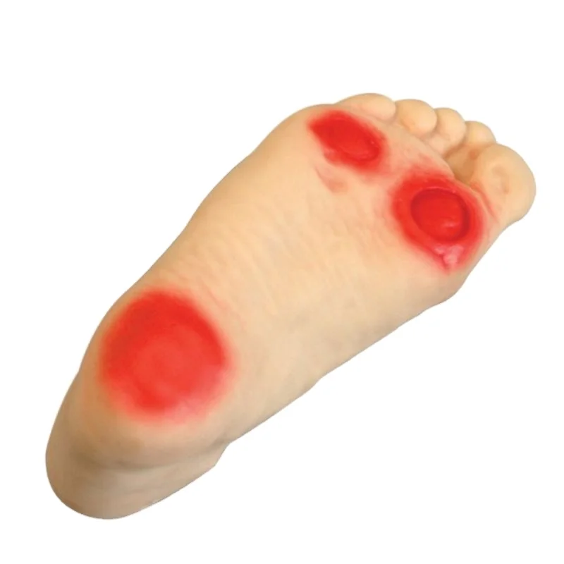 Anatomical Human Plastic diabetic foot ulceration nursing Model, Demonstration of foot lesions and diabetic foot pain