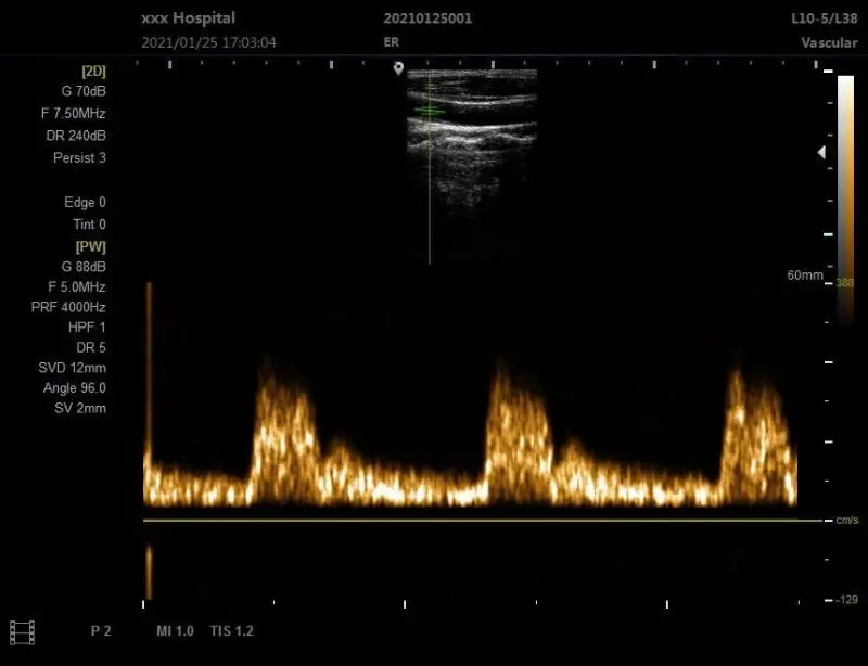 SUN-806H professional small 2D black and white ultrasound scanning blood vessel medical machine