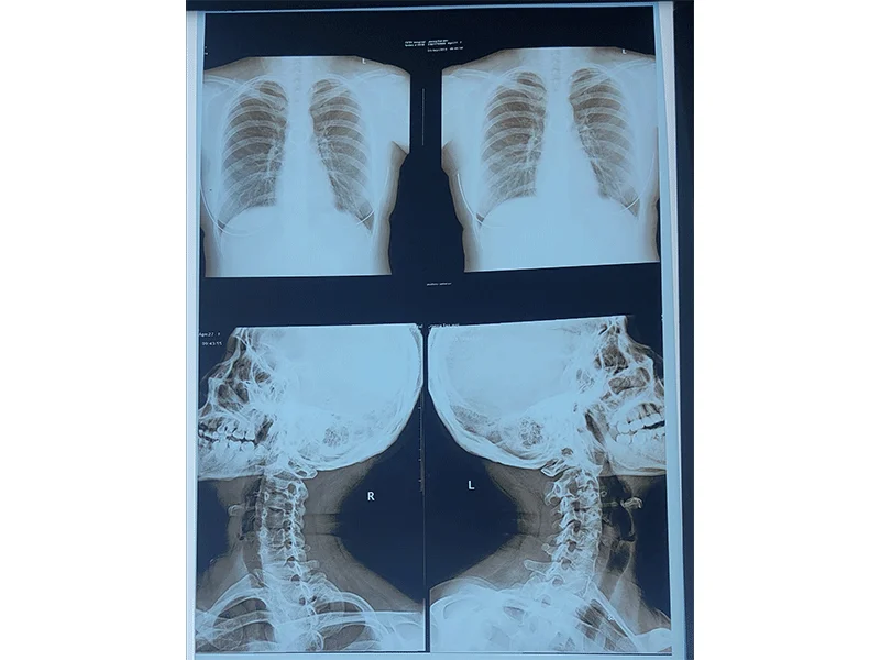 Inkjet Blue Medical X-ray Film