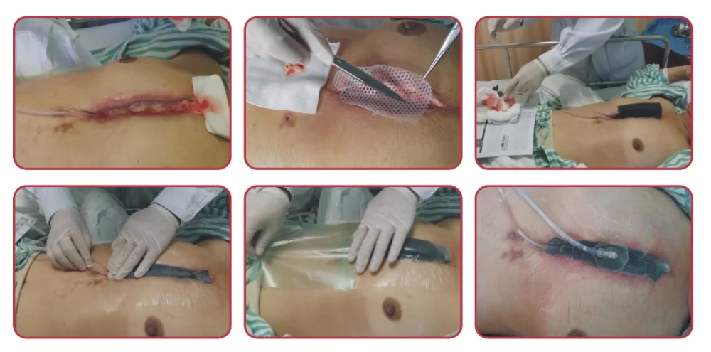 BLUENJOY China Manufacture Qualified Disposable NPWT Foam Dressing Black Negative Foam for Wound Care