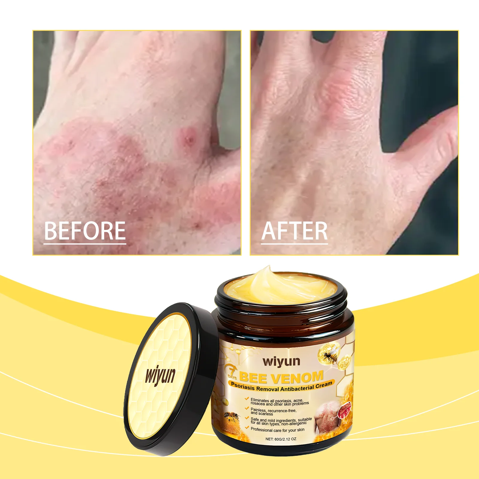 Bee Venom Psoriasis Antibacterial Cream Effective Skin Cream Gentle Original Skin Cream