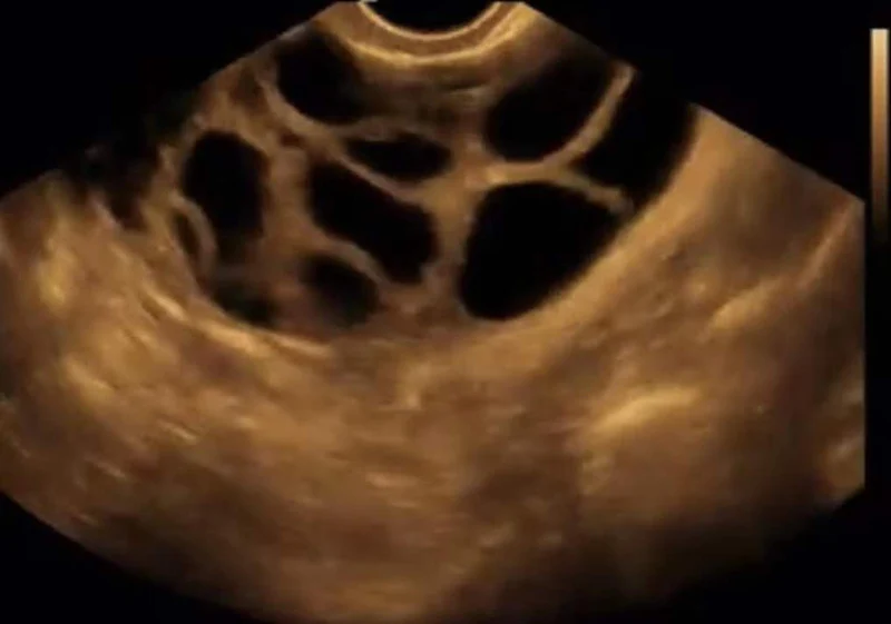 Transvaginal Single Wireless Ultrasound Probe for GY OB