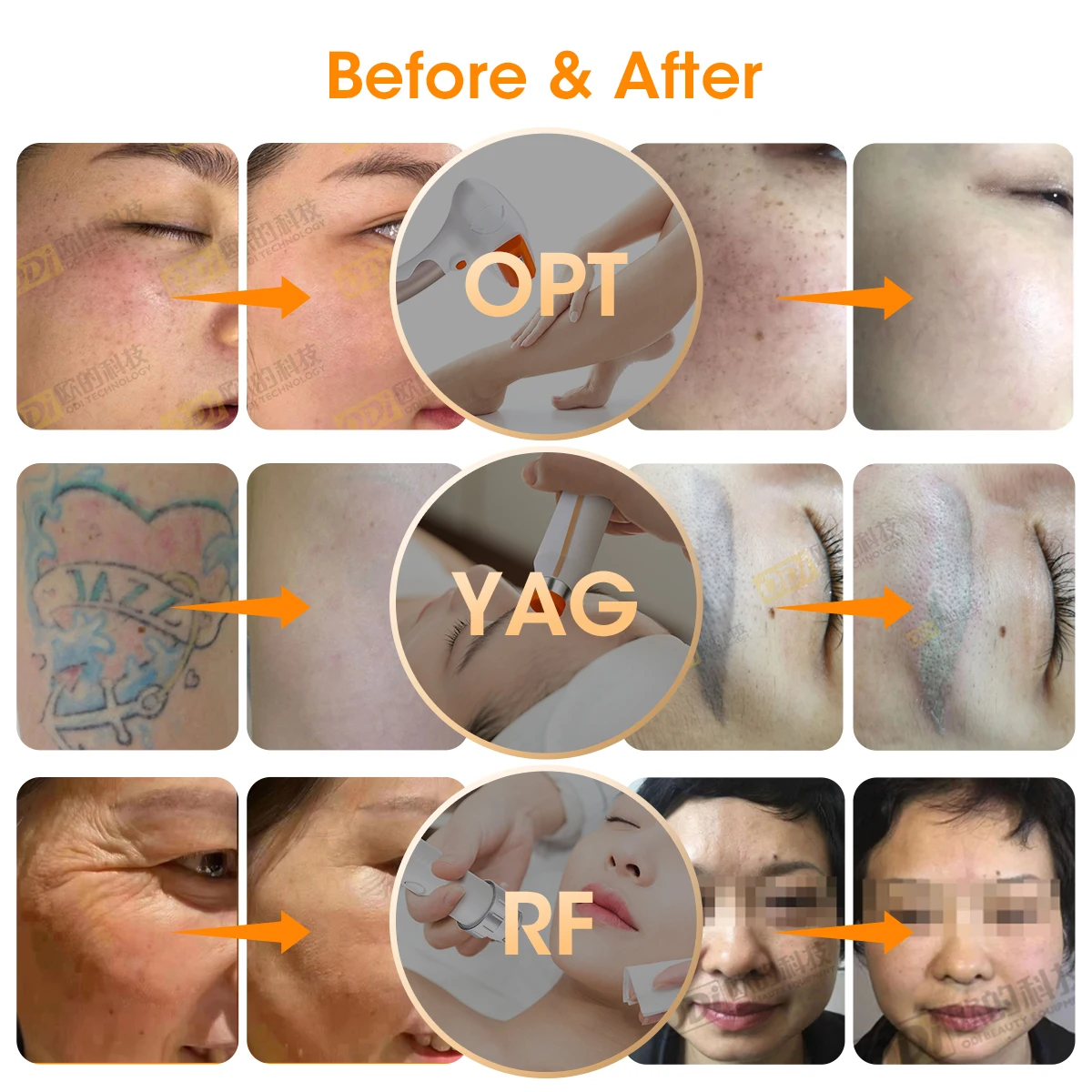 IPL Elight RF Pico 4 In 1 Laser Machine 4 In 1 Opt IPL RF Nd Yag Permanent Laser Tattoo