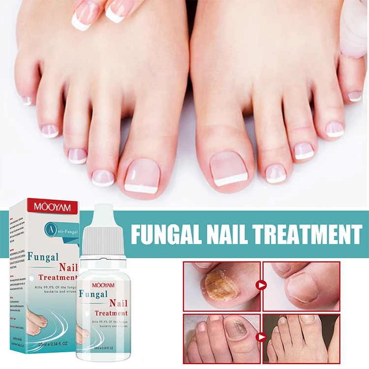 Renew Herbal Anti Fungal Nail Infection Foot Toe Fungal Nail Treatment Oil for Fungus Treatments Oil