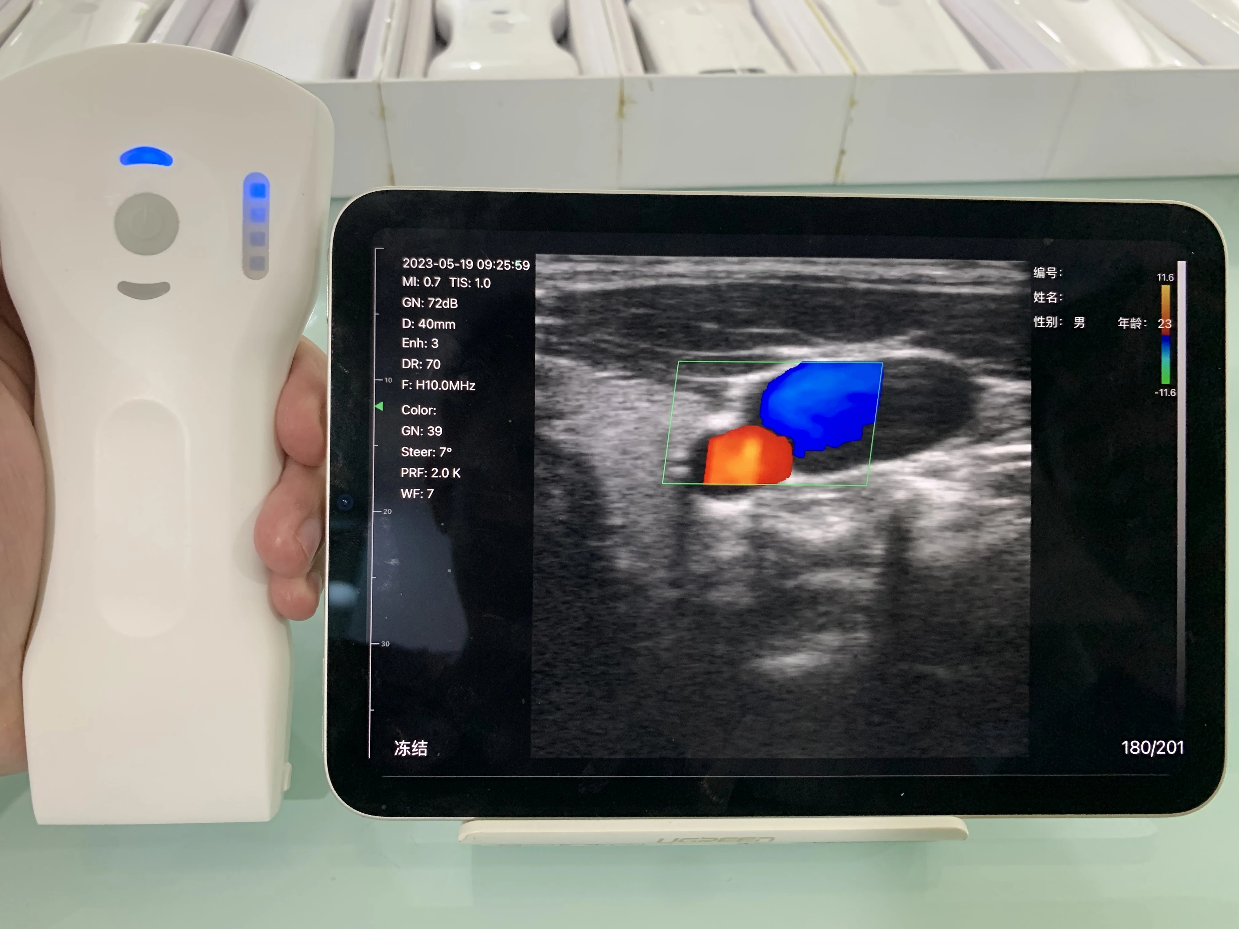 Suresult Color Doppler On-the-Go Solutions For Emergency Medicine: Portable Ultrasound With Convex Probe