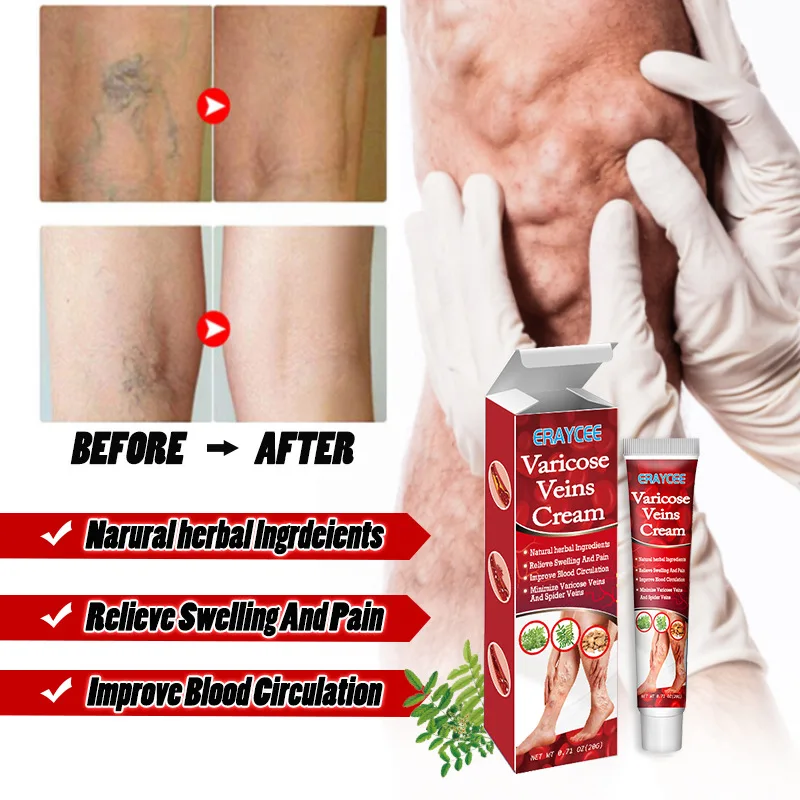 20g  Varicose Veins Cream Varicosity Angiitis Phlebitis Leg Veins Pain Plaster Health Care