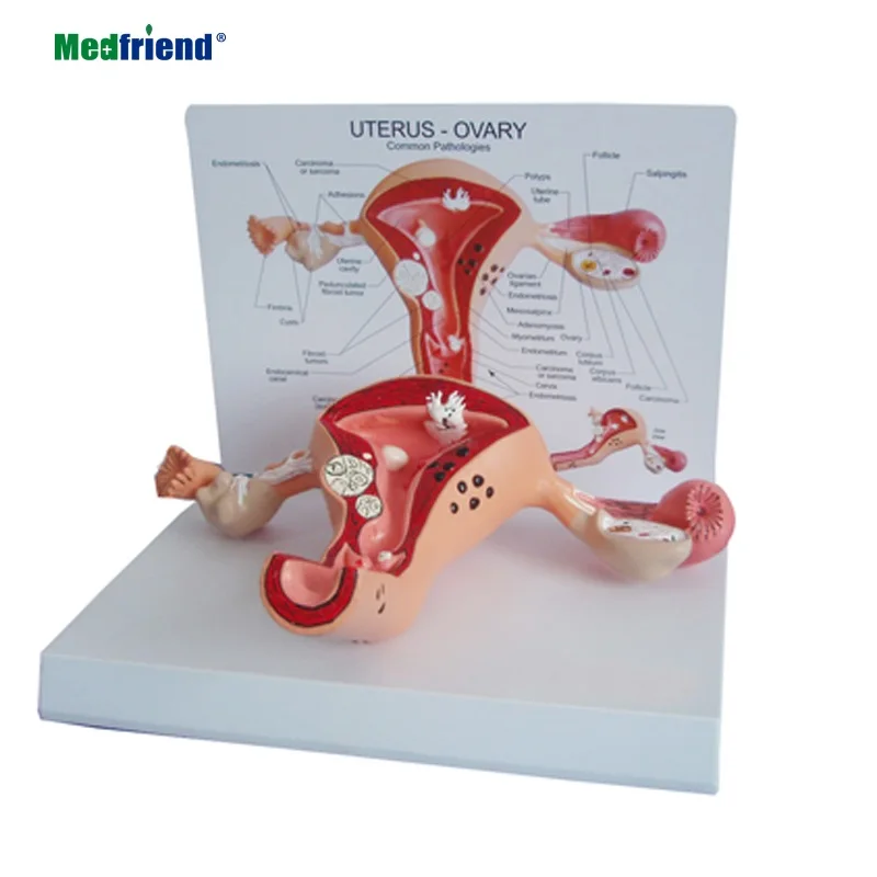 
Factory Price Anatomical Female Uterus Ovary Model with Pathologies 