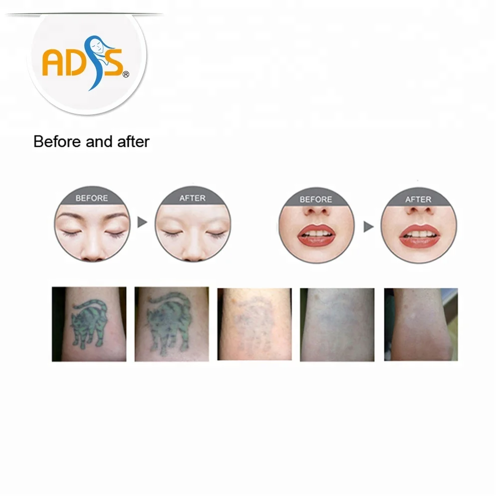 professional Q Switch nd yag laser tattoo removal machine/tatto laser removal machine