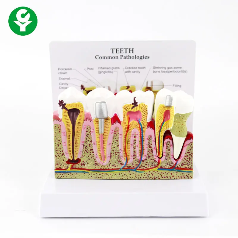 Dental Study Plastic Periodontal Teeth Human Medical Decay Common Pathologies Teeth Model