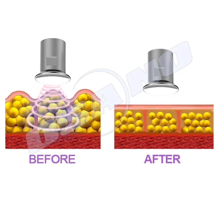 OSANO acoustic wave therapy shock wave weight loss machine shockwave therapy