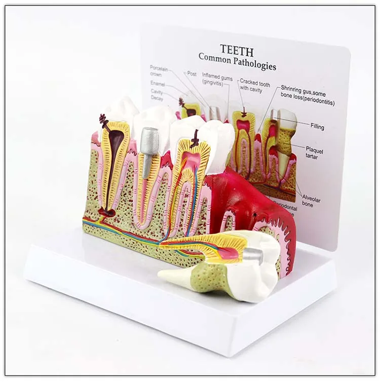 Dental Study Plastic Periodontal Teeth Human Medical Decay Common Pathologies Teeth Model