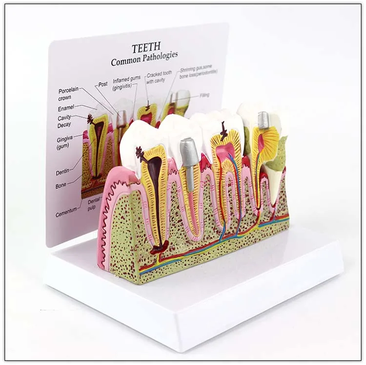 Dental Study Plastic Periodontal Teeth Human Medical Decay Common Pathologies Teeth Model