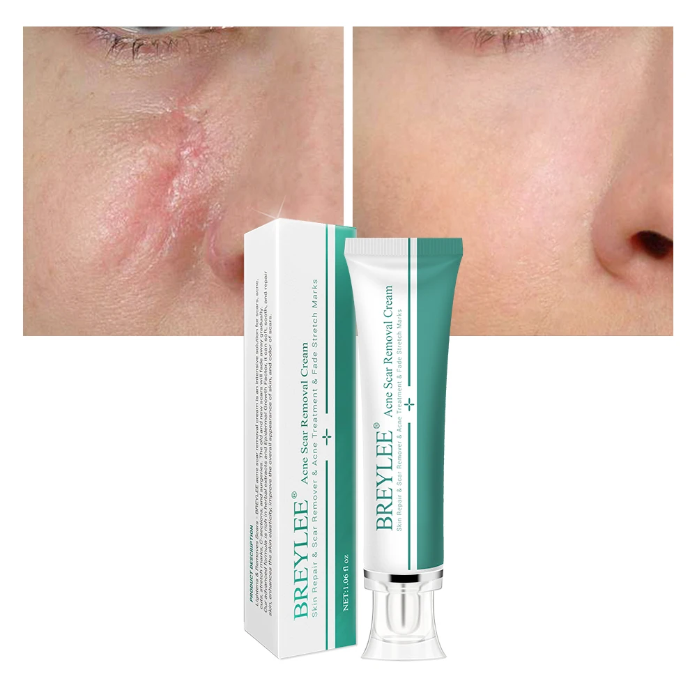 Крем для удаления шрамов от акне BREYLEE Stretch mark